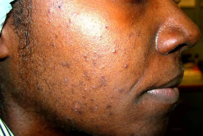 Home Remedies for Acne: How to Stop Acne